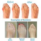 Clea | Bunion Corrector Sandals | Women's Orthopedic, Arch Support | Wedge